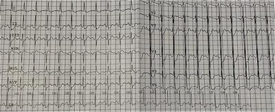 Case report: Combination of veno-arterial extracorporeal membrane oxygenation and intra-aortic balloon pump in a young male patient with refractory cardiogenic shock due to aluminum phosphide poisoning